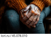 Joints inflammation, rheumatoid arthritis, age-related degenerative changes in the hands. Стоковое AI-изображение, AI-художник Станислав Тарко / Фотобанк Лори
