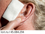 Ear diseases earwax. Ear with rinsing solution, close-up. Instillation of hydrogen peroxide drops into a man's ear to soften the earwax. Стоковое фото, фотограф Коханова Наталья / Фотобанк Лори