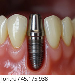 A close-up of a dental implant placed in the gum, without a crown. The implant is made of metal and is precisely placed between natural teeth. Healthy pink gums and adjacent teeth highlight the high quality of the dental work. The photograph is done in a detailed, realistic style, suitable for use in medical, dental and educational contexts where it is necessary to demonstrate the implant process. Стоковое AI-изображение, AI-художник Анна Кривицкая / Фотобанк Лори