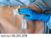 Hands of medic or nurse in blue gloves examining a fresh suture on a male stomach after laparoscopy surgical removal of appendicitis. Doctor examines of the patient. Man belly with medical stitches. Стоковое фото, фотограф Марина Демидюк / Фотобанк Лори