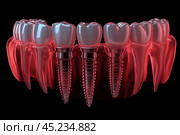 A 3D illustration of dental implants integrated into a row of teeth. The metal screws of the implants are visible, replacing the roots of the teeth, and artificial crowns are placed on top. The gum is visualized in a translucent red color, which emphasizes the structure of the implants and their location in the jaw. This image is ideal for use in medical materials related to dental implants, dentistry and surgical procedures. Стоковое AI-изображение, AI-художник Анна Кривицкая / Фотобанк Лори