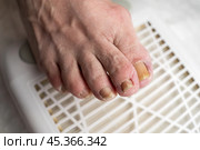 Hardware pedicure, ingrown toenail, elderly woman with cracked skin on her foot at a podiatrist's appointment, chiropody and podology concept. Стоковое фото, фотограф Станислав Тарко / Фотобанк Лори
