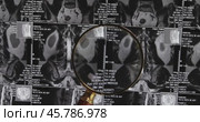 MRI lumbar spine background, magnetic resonance tomography. Doctor examines MRI of lumbar spine with pinched discs of spine and nerves. Стоковое видео, видеограф Андрей Армягов / Фотобанк Лори