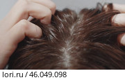 A woman scratching her scalp, feeling discomfort and irritation. Стоковое видео, видеограф Илья Шаматура / Фотобанк Лори