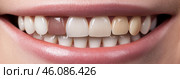 Multicolored false teeth. unsuccessful veneers. Colorful artificial teeth. A smile with an example of the shades of teeth. Стоковое AI-изображение, AI-художник Анна Чижова / Фотобанк Лори