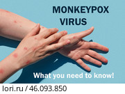 Phrase MONKEYPOX VIRUS what you need to know. Monkeypox new disease dangerous over the world. Patient with Monkey Pox. Painful rash, red spots blisters. Close up human hands with Health problem. Стоковое фото, фотограф Марина Демидюк / Фотобанк Лори