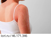 Woman with red sunburned skin against light background, closeup. Стоковое фото, фотограф Pixel_shot / Фотобанк Лори