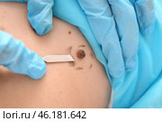 Doctor with lancet going to remove mole from patient's skin, closeup. Стоковое фото, фотограф Pixel_shot / Фотобанк Лори