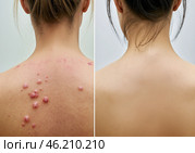 До и после лечения кожи для удаления кожных бугорков, угрей и высыпаний на спине. Стоковое AI-изображение, AI-художник Anna Leeva / Фотобанк Лори