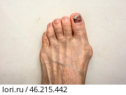 Подногтевая гематома через 6 месяцев после травмы ноги тесной обувью. Skier’s Toe is characterised by bleeding under the nail bed. The medical term for a Skier’s Toe is a Subungual Haematoma. Subungual hematoma 6 months after a leg injury from tight shoes. The effect of wearing uncomfortable shoes. Pedicure and podiatry. Medicine concept foot isolated on white. Стоковое фото, фотограф Iva Noel / Фотобанк Лори