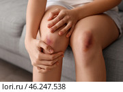 Young woman with bruised legs sitting on sofa at home, closeup. Стоковое фото, фотограф Pixel_shot / Фотобанк Лори
