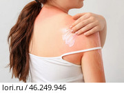 Woman with red sunburned skin applying cream against light background, closeup. Стоковое фото, фотограф Pixel_shot / Фотобанк Лори