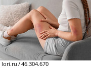 Young woman with bruised leg sitting on sofa at home. Стоковое фото, фотограф Pixel_shot / Фотобанк Лори