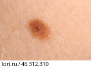 Human skin with mole, closeup. Стоковое фото, фотограф Pixel_shot / Фотобанк Лори