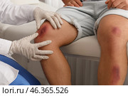 Doctor examining man with bruises in clinic, closeup. Стоковое фото, фотограф Pixel_shot / Фотобанк Лори