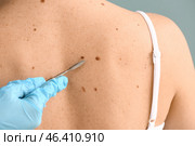 Doctor with lancet going to remove mole from patient's skin, closeup. Стоковое фото, фотограф Pixel_shot / Фотобанк Лори