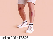 Man with bruises on legs against beige background. Стоковое фото, фотограф Pixel_shot / Фотобанк Лори
