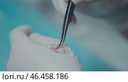 Doctor Examining Hair Grafts Before Hair Transplant Surgery. Стоковое видео, видеограф Михаил Матвеев / Фотобанк Лори