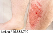 Man's leg is covered in red marks and bruises. Стоковое фото, фотограф Скрипачев Антон / Фотобанк Лори