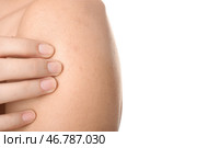 Девушка с проблемой прыщей на белом фоне, крупным планом. Стоковое фото, фотограф Pixel_shot / Фотобанк Лори