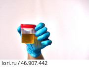 Person is holding a container of urine in a blue glove. Стоковое фото, фотограф Скрипачев Антон / Фотобанк Лори
