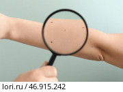 Дерматолог с увеличительным стеклом осматривает родинки на руке женщины на зеленом фоне, крупный план. Стоковое фото, фотограф Pixel_shot / Фотобанк Лори