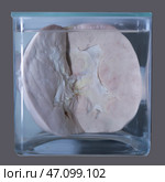 April 1, 2023. Belarus, Minsk. Exhibition of anatomical exhibits. A human kidney with a stone is an anatomical exhibit preserved in alcohol in a formaldehyde solution. Редакционное фото, фотограф Лазаренко Светлана / Фотобанк Лори