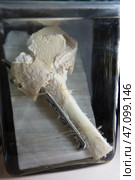 April 1, 2023. Belarus, Minsk. Exhibition of anatomical exhibits. A broken human bone is fixed with a metal plate and screws. Preserved in alcohol in a formaldehyde solution. Редакционное фото, фотограф Лазаренко Светлана / Фотобанк Лори