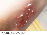 Woman with shingles on the skin she feels very painful. Стоковое фото, фотограф Anastasia Kayander / Фотобанк Лори