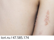 Woman with shingles on the skin she feels very painful. Стоковое фото, фотограф Anastasia Kayander / Фотобанк Лори
