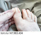 Foot fungus infection affecting the big toe, showcasing signs of irritation and discomfort on the skin. Стоковое фото, фотограф Кривошеина Елена Леонидовна / Фотобанк Лори