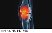 Dynamic xray knee joint with highlighted inflammation showing internal movement. Стоковое AI-видео, аниматор Владимир Федоров / Фотобанк Лори