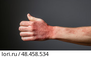 irritation red skin ai generated. Стоковое AI-изображение, AI-художник Vectorwin / Фотобанк Лори