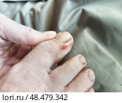 Treatment and inspection of foot fungus affecting the big toe in a clinical setting. Стоковое фото, фотограф Кривошеина Елена Леонидовна / Фотобанк Лори