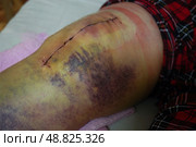 Postoperative suture on woman's leg. Closeup of scar after knee fracture. Traces of interrupted sutures leg after surgery. Recovery and wound healing concept. Стоковое фото, фотограф Ирина Старикова / Фотобанк Лори