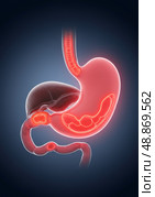 Human stomach showing acid reflux and esophagus, liver, duodenum. Стоковое AI-изображение, AI-художник Гайфуллина Дина / Фотобанк Лори