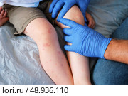 Doctor examining child with bodily red rash. Kid allergy closeup. Little baby scratches an eruption. Nurse applies special cream to atopic skin. Dermatitis, irritation, hive. Pruritus. Mosquito bites. Стоковое фото, фотограф Марина Демидюк / Фотобанк Лори