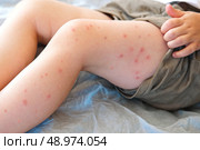 Child scratch body has sensitive itchy skin. Bodily rash. Kid allergy closeup. Little baby scratches eruption. Irritation, hive. Pruritus. Mosquito insect bite. Red from sunburn, Seborrheic Dermatitis. Стоковое фото, фотограф Марина Демидюк / Фотобанк Лори