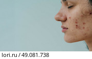 A large portrait of a young woman with skin problems - pimples, acne, enlarged pores. A place for your text. Стоковое фото, фотограф Корчагина Анастасия / Фотобанк Лори