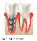 Dental Implant Tooth Set Closeup Model . Dental implants and tooth set model closeup side view realistic image vector illustration . Стоковая иллюстрация, агентство Ingram Publishing / Фотобанк Лори