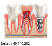 Dental Implants Anatomy Closeup Model . Dental implant and real tooth anatomy closeup cut away section model side view realistic vector illustration . Стоковая иллюстрация, агентство Ingram Publishing / Фотобанк Лори