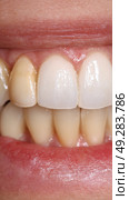 Brightened Teeth After Whitening Treatment Showcasing Smooth Enamel and Uniform Color. Стоковое AI-изображение, AI-художник Юлия Гапеенко / Фотобанк Лори