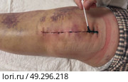 Medical sutures, stitch after surgery, stitched surgical sutures on human body smeared betadine. Medical surgical care. Close-up. Стоковое видео, видеограф Ирина Старикова / Фотобанк Лори