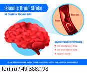 Ischemic brain stroke realistic poster with symptoms list and call to be careful to save life vector illustration. Ischemic Brain Stroke Poster. Стоковая иллюстрация, агентство Ingram Publishing / Фотобанк Лори