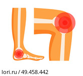 Orthopedic problems in foot and knee, localisation showed with help of red circle on human body parts organism, set isolated on vector illustration. Orthopedic Problems in Foot Vector Illustration. Стоковая иллюстрация, агентство Ingram Publishing / Фотобанк Лори