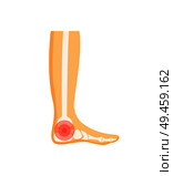 Foot pain human body illness of leg, painful feeling in limb with circle on it as sore pain symbol, vector illustration isolated on white background. Foot Pain Human Body Illness Vector Illustration. Стоковая иллюстрация, агентство Ingram Publishing / Фотобанк Лори