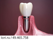 Detailed close-up view of a tooth surgically implanted in the jaw, showing the intricate structure and placement within the gumline. Стоковое AI-изображение, AI-художник Данила Большаков / Фотобанк Лори