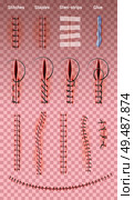 Surgical suture stitches realistic set of images on transparent background with different shapes of medical stitching vector illustration. Стоковая иллюстрация, агентство Ingram Publishing / Фотобанк Лори