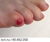 Close-Up of Toe with Callous or Red Blister Condition. Стоковое фото, фотограф Мара Фрибус / Фотобанк Лори