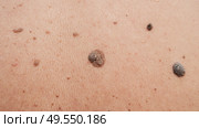 Moles and birthmarks on human skin close-up. Стоковое фото, фотограф Корчагина Анастасия / Фотобанк Лори